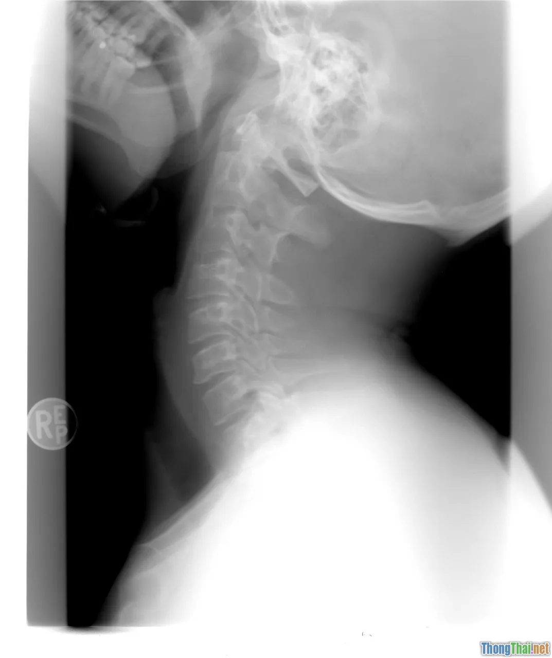 spine injury, neck brace, immobilization