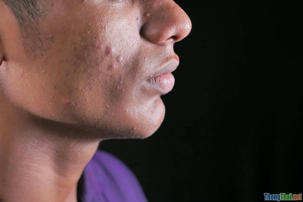 cushion criteria, oily acne skin