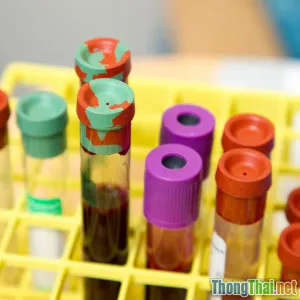 Bí quyết trị tiểu đường nhờ công nghệ gene cá nhân hóa