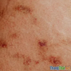 Bệnh viêm da ở thú cưng có lan sang người không Góc nhìn bác sĩ