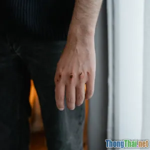 Có nên sơ cứu vết cắt bằng cồn Tranh cãi giữa truyền thống và khoa học